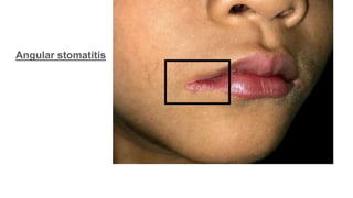 Anemia: classification, IDA, Megaloblastic anemia - General Medicine ...