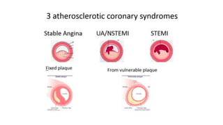 Ischemic Heart Disease - Medicine - ATOT | PPTX