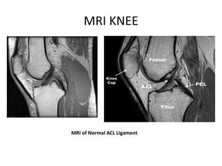 A TO Z OF ACL INJURIES | PPTX