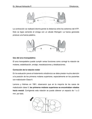 Dr. Manuel Adriazola P. Ortodoncia
La contracción se realizará disminuyendo la distancia entre los extremos del ATP.
Esto se logra cerrando el omega con un alicate Weingart. La fuerza generada
produce una fuerza palatino.
Uso del arco transpalatino
El arco transpalatino puede cumplir varias funciones como corregir la rotación de
molares, estabilización, anclaje, mesializaciones y distalizaciones.
Corrección de la rotación molar
En la evaluación previa al tratamiento ortodóncico se debe prestar mucha atención
a la posición de los primeros molares superiores, especialmente en los pacientes
con maloclusión Clase II.
Lemons y Holmes en 1961, observaron que en la mayoría de los casos de
maloclusión clase II, los primeros molares superiores se encontraban rotados
hacia mesial. Corrigiendo esta rotación se puede obtener un espacio de 1 a 2
mm. por lado.
 