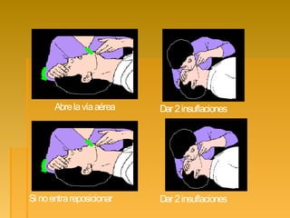 Abrelavíaaérea
Si noentrareposicionar
Dar 2insuflaciones
Dar 2insuflaciones
 