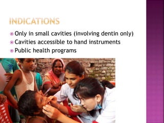  Only in small cavities (involving dentin only)
 Cavities accessible to hand instruments
 Public health programs
 