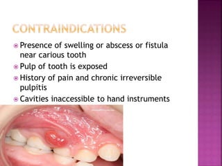  Presence of swelling or abscess or fistula
near carious tooth
 Pulp of tooth is exposed
 History of pain and chronic irreversible
pulpitis
 Cavities inaccessible to hand instruments
 