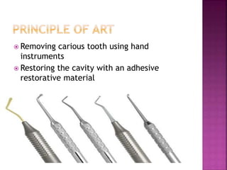  Removing carious tooth using hand
instruments
 Restoring the cavity with an adhesive
restorative material
 