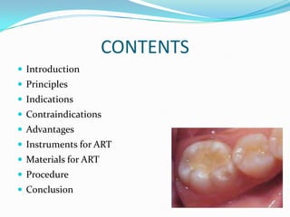 CONTENTS
 Introduction
 Principles
 Indications
 Contraindications

 Advantages
 Instruments for ART
 Materials for ART

 Procedure
 Conclusion

 