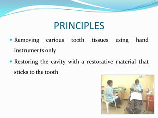 PRINCIPLES
 Removing

carious

tooth

tissues

using

hand

instruments only
 Restoring the cavity with a restorative material that

sticks to the tooth

 