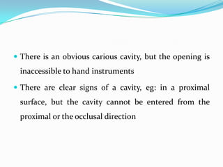  There is an obvious carious cavity, but the opening is

inaccessible to hand instruments
 There are clear signs of a cavity, eg: in a proximal

surface, but the cavity cannot be entered from the
proximal or the occlusal direction

 