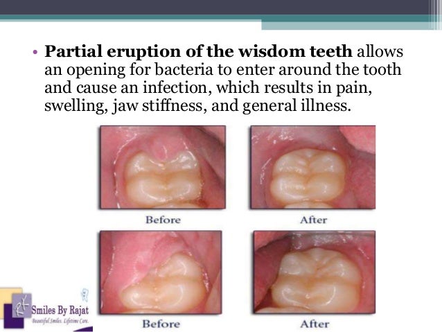 Wisdom tooth extraction infection