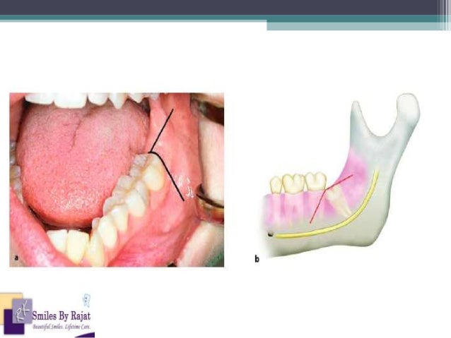 Some Ideas on Is Wisdom Teeth Removal Surgery You Need To
