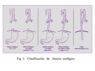 Fig. 1:  Clasificación  de  Atresia  esofágica 
