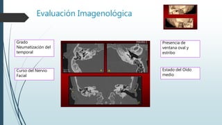 Evaluación Imagenológica
Grado
Neumatización del
temporal
Curso del Nervio
Facial
Presencia de
ventana oval y
estribo
Estado del Oído
medio
 