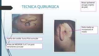 TECNICA QUIRURGICA
Brazo ipsilateral:
arrugas (injerto
de piel)
Injerto de costilla: Surco Post auricular
Antes de MEDPOR: 5 A 7 cm post
remanente auricular
Parte media se
incorporará al
meato
 