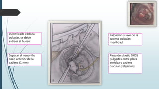 Identificada cadena
osicular, se debe
extraer el hueso
Separar el neoanillo
óseo anterior de la
cadena (1 mm)
Palpación suave de la
cadena osicular:
movilidad
Pieza de silastic 0.005
pulgadas entre placa
atrésica y cadena
osicular (refijacion)
 
