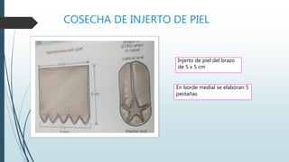 COSECHA DE INJERTO DE PIEL
Injerto de piel del brazo
de 5 x 5 cm
En borde medial se elaboran 5
pestañas
 