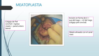 MEATOPLASTIA
Incisión en forma de U >
sup del trago > inf del trago
(colgajo piel conchal)
Meato alineado con el canal
óseo
Colgajo de Piel
conchal> ingresa
meato > pared antero
lateral
 