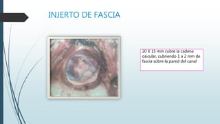 INJERTO DE FASCIA
20 X 15 mm cubre la cadena
osicular, cubriendo 1 a 2 mm de
fascia sobre la pared del canal
 