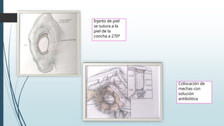 Colocación de
mechas con
solución
antibiótica
Injerto de piel
se sutura a la
piel de la
concha a 270ª
 