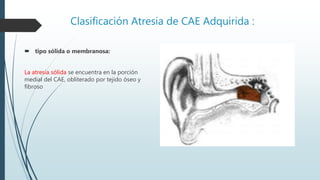 Clasificación Atresia de CAE Adquirida :
 tipo sólida o membranosa:
La atresia sólida se encuentra en la porción
medial del CAE, obliterado por tejido óseo y
fibroso
 