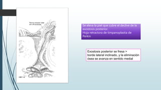 Exostosis posterior se fresa >
borde lateral inclinado, y la eliminación
ósea se avanza en sentido medial
Se eleva la piel que cubre el declive de la
exostosis posterior.
Hoja retractora de timpanoplastia de
Perkin
 