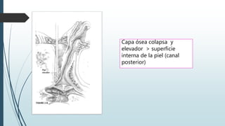 Capa ósea colapsa y
elevador > superficie
interna de la piel (canal
posterior)
 