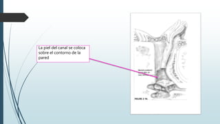 La piel del canal se coloca
sobre el contorno de la
pared
 
