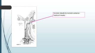 Incisión desde la incisión anterior
hasta el meato
 