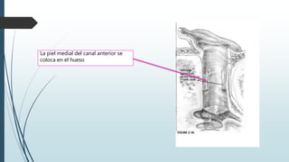 La piel medial del canal anterior se
coloca en el hueso
 