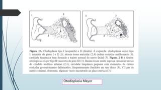 Otodisplasia Mayor
 