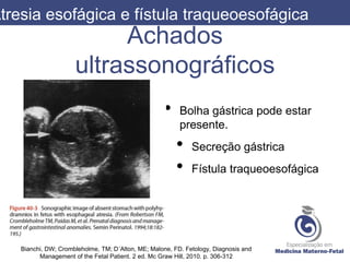Achados
ultrassonográficos
• Bolha gástrica pode estar
presente.
• Secreção gástrica
• Fístula traqueoesofágica
Atresia esofágica e fístula traqueoesofágica
Bianchi, DW; Crombleholme, TM; D´Alton, ME; Malone, FD. Fetology, Diagnosis and
Management of the Fetal Patient. 2 ed. Mc Graw Hill, 2010. p. 306-312
 