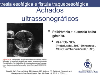 Achados
ultrassonográficos
• Polidrâmnio + ausência bolha
gástrica.
• VPP 30-70%.
(Pretoriusetal.,1987;Stringeretal.,
1995; Crombleholmeetal.,1996).
Atresia esofágica e fístula traqueoesofágica
Bianchi, DW; Crombleholme, TM; D´Alton, ME; Malone, FD. Fetology, Diagnosis and
Management of the Fetal Patient. 2 ed. Mc Graw Hill, 2010. p. 306-312
 