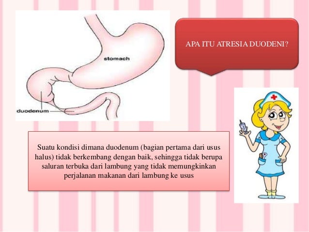 Atresia duodeni