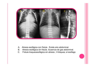 A. Atresia esofágica con fístula . Existe aire abdominal.
B. Atresia esofágica sin fístula .Ausencia de gas abdominal.
C. Fístula traqueoesofágica sin atresia ; t=tráquea; e=esófago
 