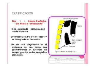 CLASIFICACIÓN
Tipo I : Atresia Esofágica
sin fístula o “atresia pura”
No existiendo comunicación
con la vía aérea.
Representa el 5% de los casos y
es la segunda en frecuencia.
Es de fácil diagnóstico en el
embarazo ya que cursa con
polihidramnios y ausencia de
imagen gástrica en las ecografías
prenatales.
 