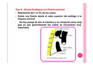 Tipo II : Atresia Esofágica con Fistula proximal
Representa del 1 al 3% de los casos.
Existe una fístula desde el cabo superior del esófago a la
tráquea cervical.
No hay pasaje de aire al intestino y se comporta como long
gap ya que generalmente los cabos se encuentran muy
separados.
 
