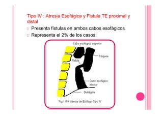Tipo IV : Atresia Esofágica y Fistula TE proximal y
distal
Presenta fístulas en ambos cabos esofágicos
Representa el 2% de los casos.
 