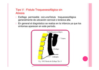 Tipo V : Fistula Traqueoesofágica sin
Atresia
Esófago permeable con unafístula traqueoesofágica
generalmente de ubicación cervical o torácica alta.
En general el diagnóstico se realiza en la infancia ya que los
síntomas aparecen en este período.
 