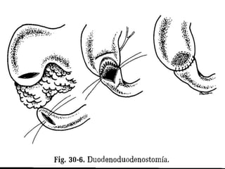 TRATAMIENTODescompresión gástrica.Corrección de líquidos y electrolitos.Es necesario excluir otros diagnosticos.Correcion quirurgica.