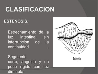 La descompresión nasogastrica posoperatoria se prefiere en vez de  gastrostomía.
