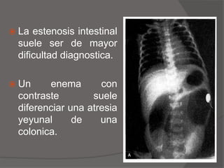 ATRESIA TIPO III (A)No hay cordón fibroso que una los extremos y hay una anomalía mesentérica en forma de V.La porción proximal y distal terminan en forma ciega.
