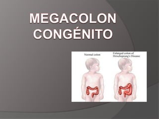 TRATAMIENTOReanimacion de volumen y electrolitos.Descompresión con sonda naso gástrica.Técnica quirúrgicas mas frecuentementeResección del intestino proximal y dilatado con anastomosis primaria termino-terminal