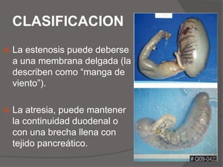 CLASIFICACIONLa estenosis puede deberse a una membrana delgada (la describen como “manga de viento”).La atresia, puede mantener la continuidad duodenal o con una brecha llena con tejido pancreático.