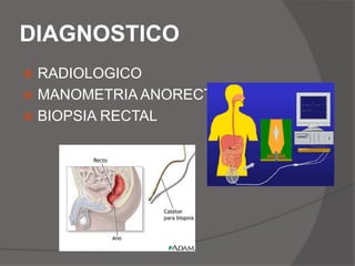 Se caracteriza por la ausencia  de las células ganglionares de los plexos mientericos de Meissner y de Auerbach.