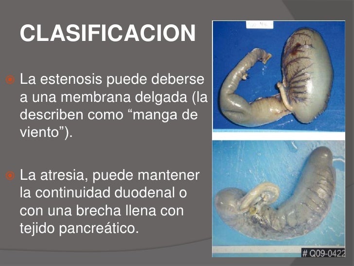 Atresia intestinal Atresia intestinal