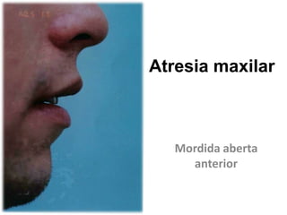 Atresia maxilar Mordida aberta anterior 