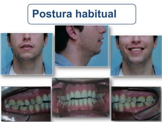 Atresia Maxilar Com Mordida Aberta