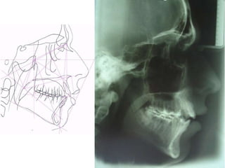 Atresia Maxilar Com Mordida Aberta