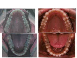 Atresia Maxilar Com Mordida Aberta