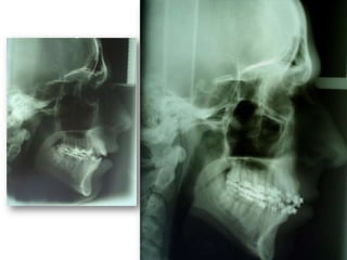 Atresia Maxilar Com Mordida Aberta