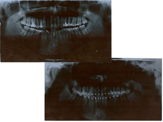 Atresia Maxilar Com Mordida Aberta