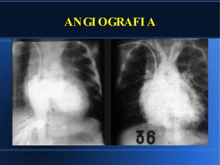 ANGIOGRAFIA 